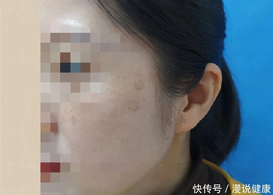 长期熬夜|女子熬夜10年长出老年斑:每天睡6小时,跟睡8小时有何区别