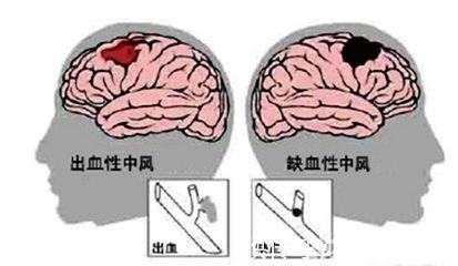 脑栓塞|脑梗到来前身体会有什么症状怎么能抵挡脑梗
