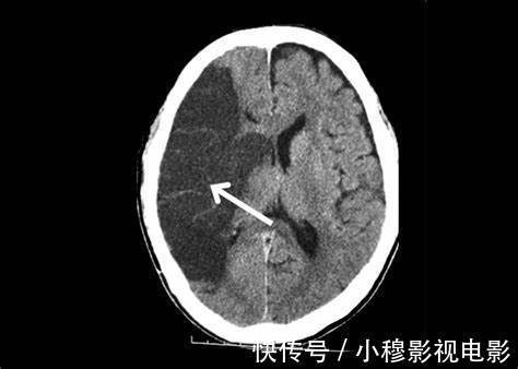 测量血压|能发现高血压,就已经及格了?医生提醒:高危人群最好半年测一次