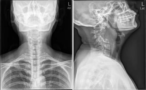 椎体|脊柱常见肿瘤及肿瘤样病变的几种影像学表现，你都见过吗？