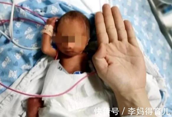 早产|一女婴早产体重仅560克,和成人巴掌差不多大,后奇迹存活