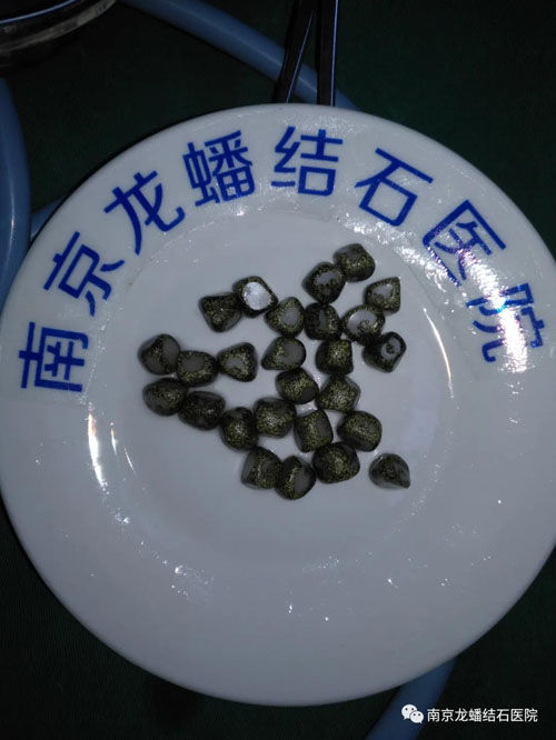 南京龍?bào)唇Y(jié)石醫(yī)院：得了結(jié)石有哪些忌口？
