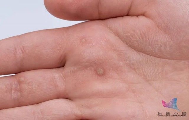 皮损|身上莫名长出的＂小揪揪＂，皮肤病还是HPV感染了？这篇文章全说清了