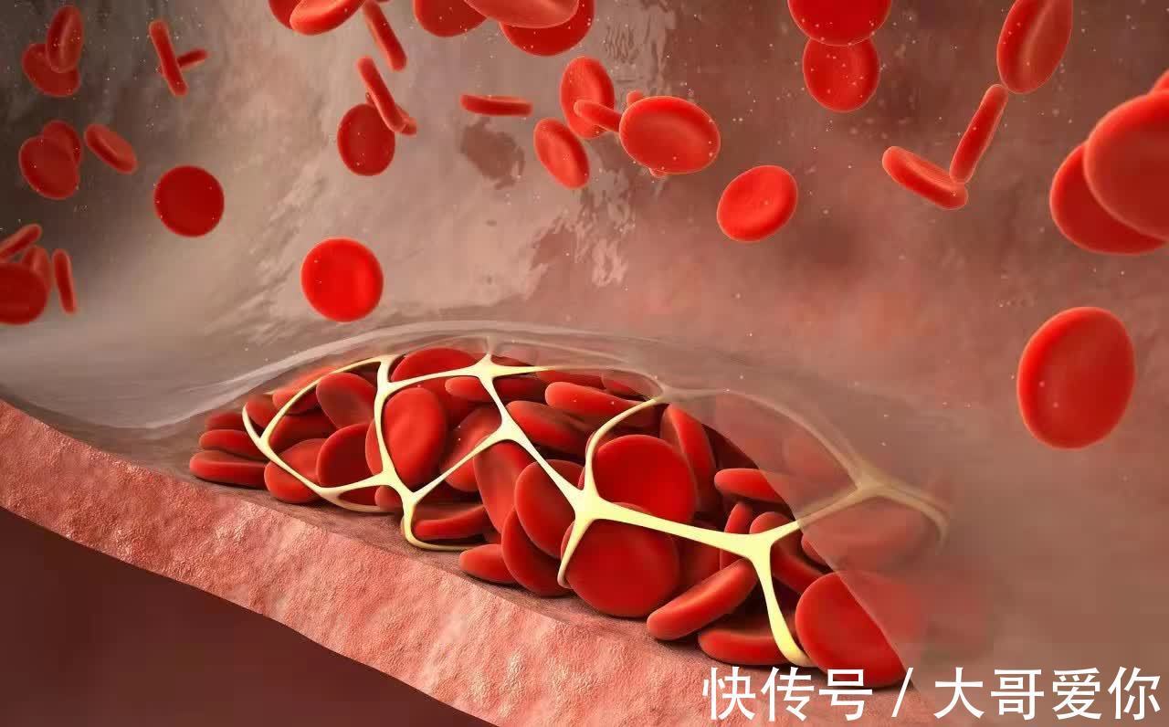 服用|冠心病长期服用他汀,冠脉斑块会消失吗?医生告诉您实情