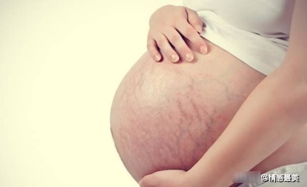 肚皮|有的女性怀孕不长妊娠纹，可能是这些原因，做到了你也可以不长！