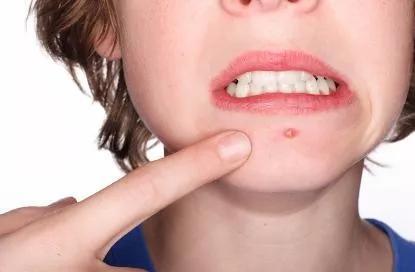 为什么你的痘痘永远反反复复消不下去?爆痘女孩必看