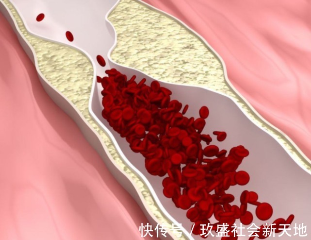 老刘|多名院士联合呼吁停止食用,比碘盐还伤血管,提醒爸妈:尽早撤下餐桌
