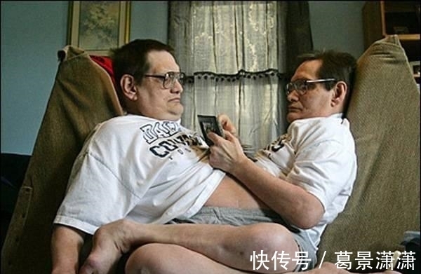 去世|连体人若有一个去世了，另一个会如何？真相让人难以接受！