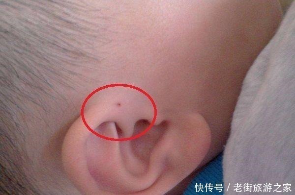 发炎|如果宝宝耳朵上有小孔，千万别乱碰，后果比你想象严重