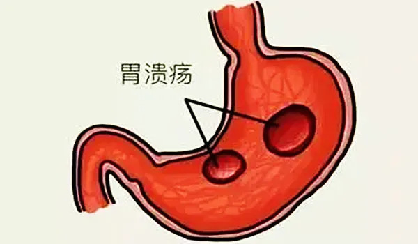 四联疗法双刃剑，不良反应是隐患|大白话说中医第一百六十期| 四联