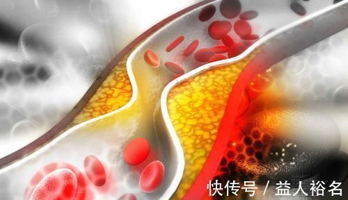 黑木耳|血栓的克星找到了，5种食物“专攻”血栓，不喜欢吃亏大了