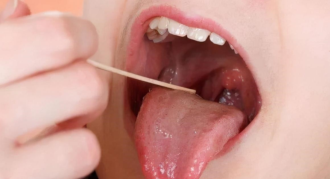 扁桃体结石|同学嫌弃儿子“嘴太臭”,妈妈带孩子检查,医生取出的颗粒是真臭