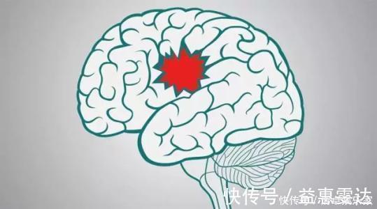 夹层|专家提醒：年轻人瑜伽运动不当容易造成中风！