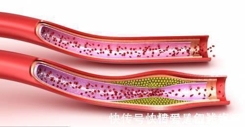 高热量|96岁中医控制血脂很简单,家中常备1杂粮,助你血管如“清水”