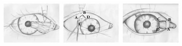 翼状胬肉|希玛林顺潮眼科医院：夏季防晒除了要防“口罩脸”，也要注意眼睛的防晒