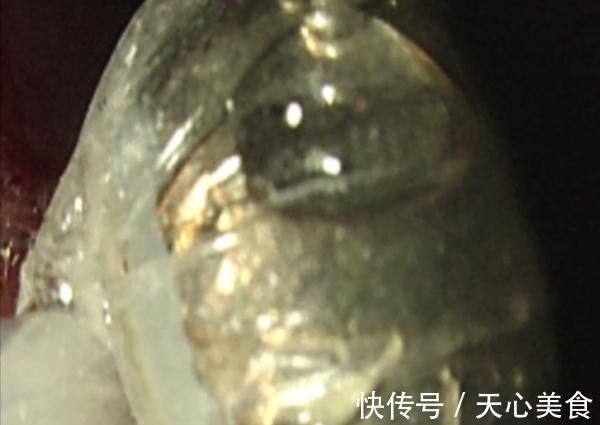 纽扣电池|男童好奇误吞纽扣电池后送医,家长觉得没大碍直接抱回家