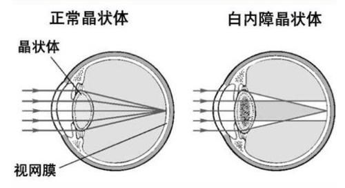  视网膜脱落的3个前兆！别拖延，及时发现及时治疗