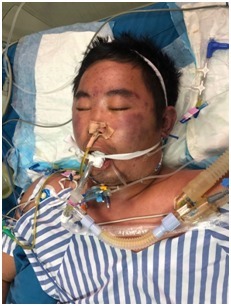 呼吸机|身上爬满红色蛛网，气道壁长出黑色锈斑，33岁的他遭遇生死劫，死里逃生