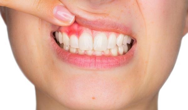 肝脏|肝硬化来临时,通常会有这4种异常,占一个,也要引起注意