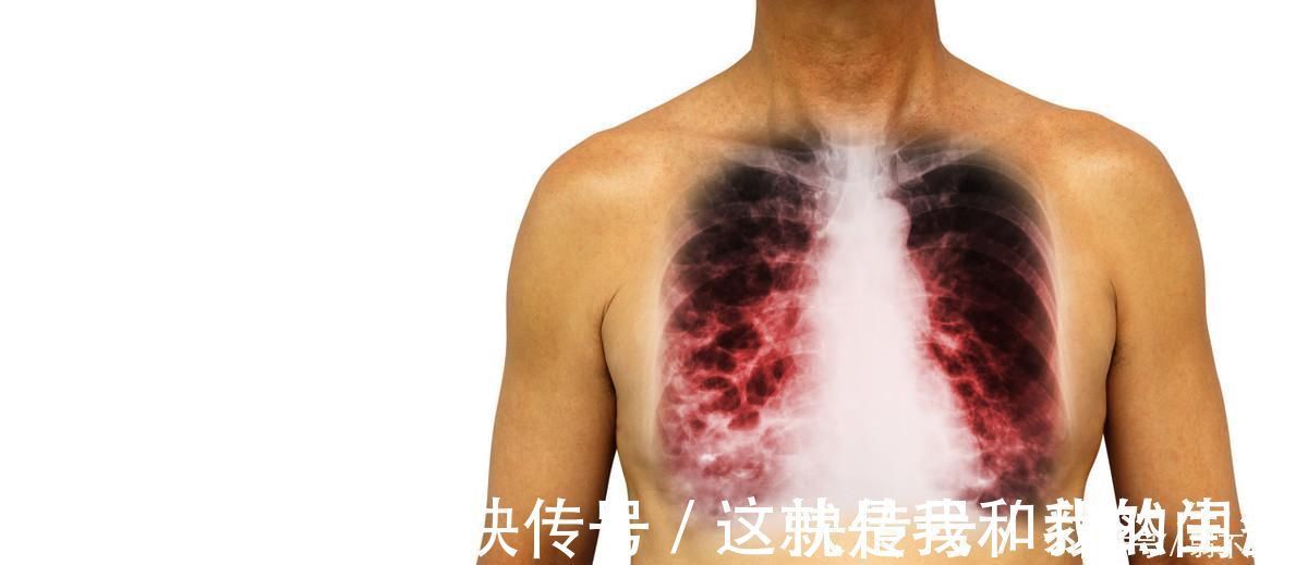 肺癌|吸烟者,身体一旦出现“1大2痛”,八成是肺癌上身,具体指什么