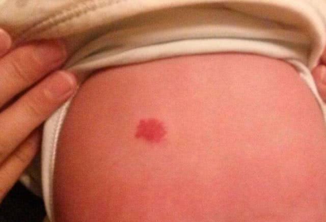 胎记|怀孕时,孕妇最好别做这4事,当心宝宝身上会留“胎记”,再喜欢也要忍住