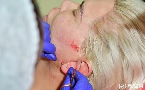 整容所|巴西男子整容成瘾,为完美身材切除4根肋骨,如今长这样