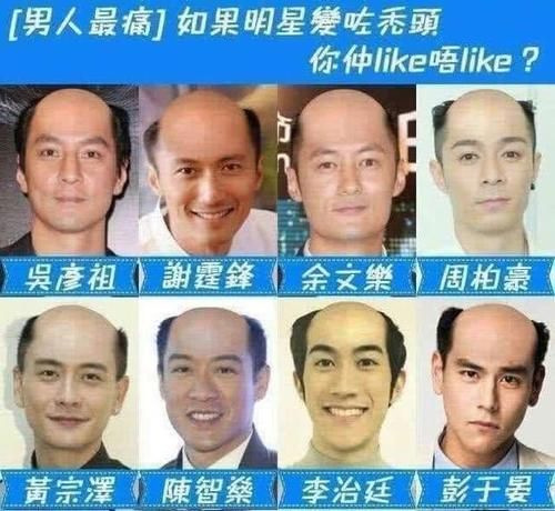 你以后会秃头吗，导致秃头的原因有哪些，有什么解决方法？