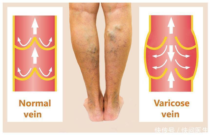 体内有栓,腿先知!提醒:腿部若有这3个表现,提示血管变窄了