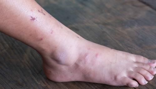 现象|肝不好,脚知道?提醒:若脚有这4个现象,警惕肝脏或许出现病变