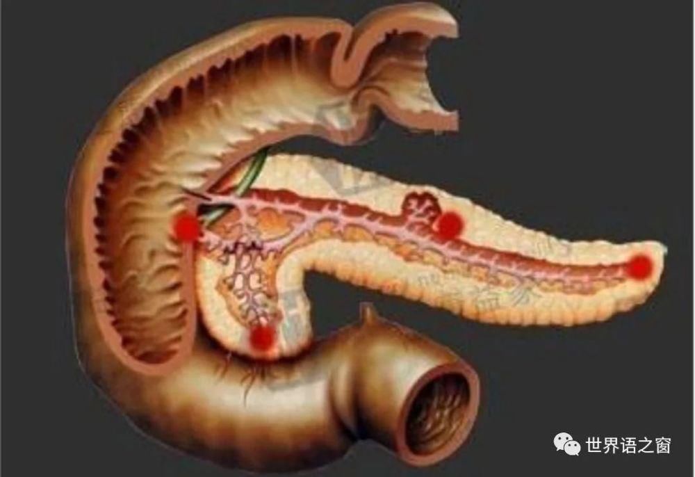 急性胰腺炎的发生和预防