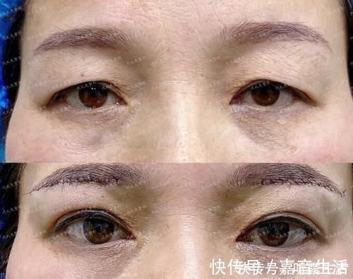 筋膜 提眉手术多久恢复自然?提眉手术可以维持多久?提眉手术疼吗?