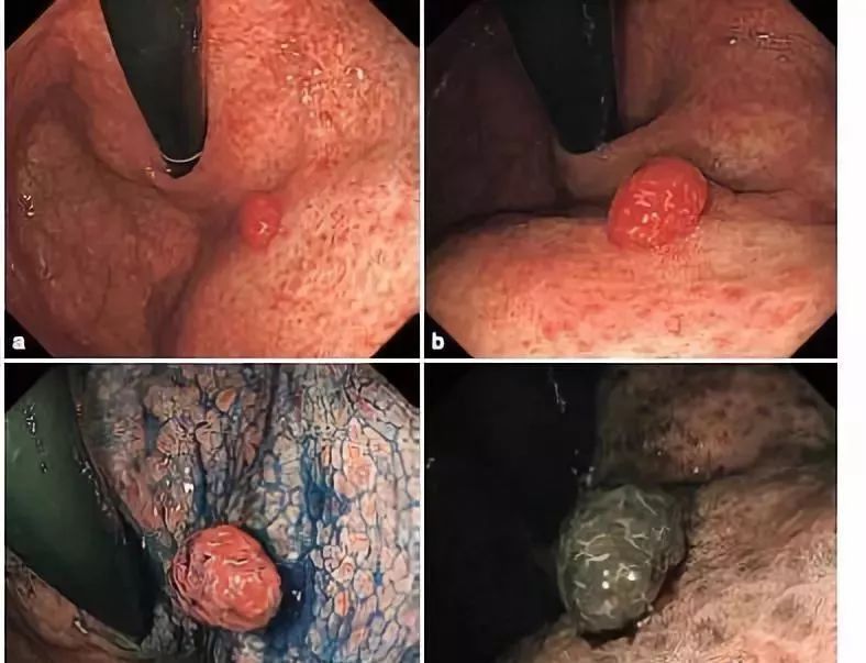 艾灸|大家好!我叫“息肉”,癌症的近亲!我最怕无情又温柔的手术刀艾灸