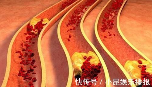 血管|一旦患有高血脂，再穷也要吃它，清血管垃圾，血脂悄悄降下来
