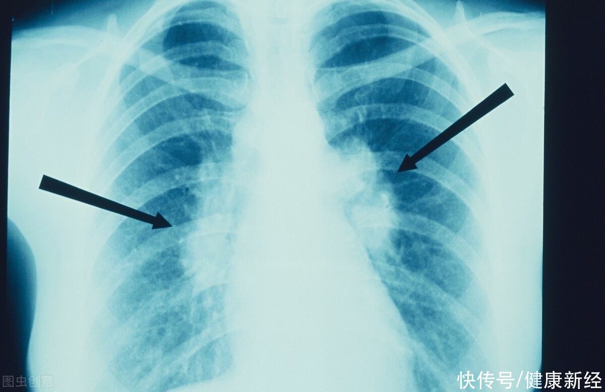 急性发作|肺结节来袭，身体会出现3个状况，如果你没有，肺还很健康