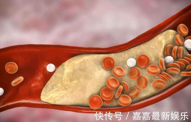 糖类物质|体内血脂高，少吃3种食物，养成4个好习惯，或有利于平衡甘油三酯