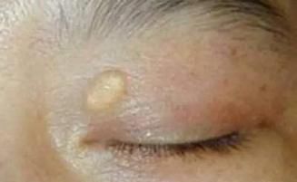 眼睑黄色瘤|高血脂的“祸根”找到了,医生警示:3种食物再吃,血液粘如粥