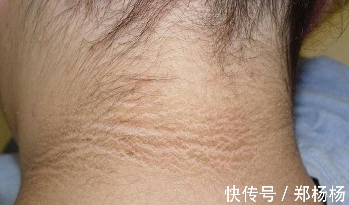 假性黑棘皮病|6岁小女孩脖颈发黑洗不掉,去医院做检查,医生的话让妈妈笑了