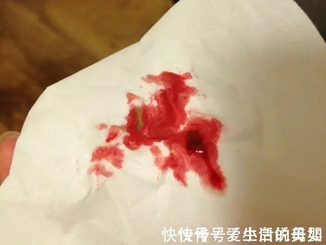 肛门处|痔疮、便血怎么办?用对了方法,原来如此简单!