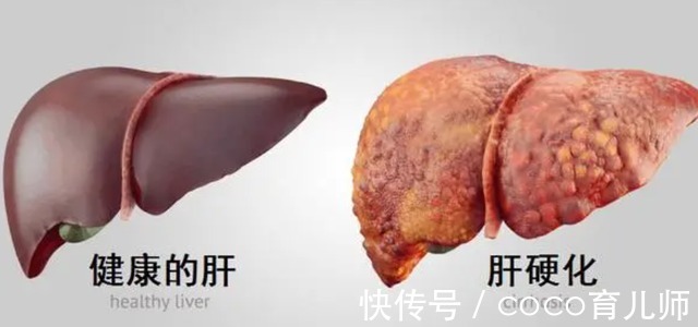 医生|转氨酶升高是肝脏不好吗？医生提醒：几个原因不容忽视