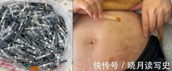 黄女士|孕期为保胎宝妈打500多针,肚子上全是淤青,但真的有必要吗?