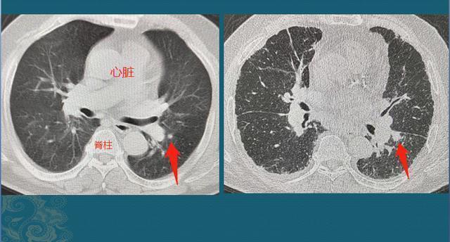 黄勇|肺腺癌是怎么长出来的医生介绍3类肺结节，像种子发芽