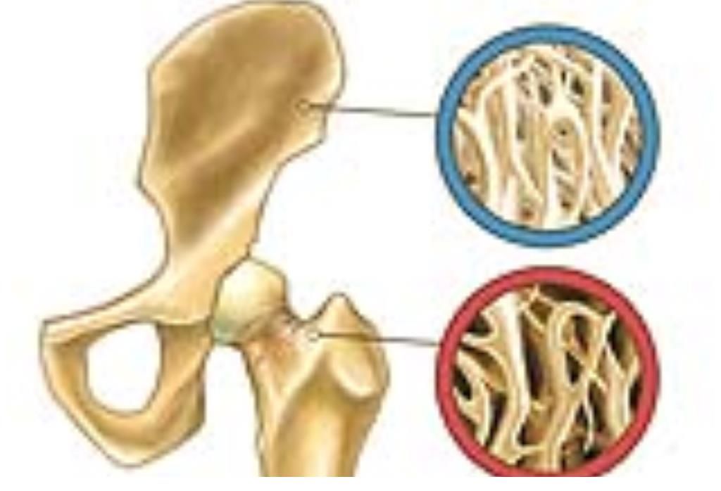 浓茶|骨质疏松的“加速器”不止浓茶，骨科医生呼吁：“2绿1白”要少吃