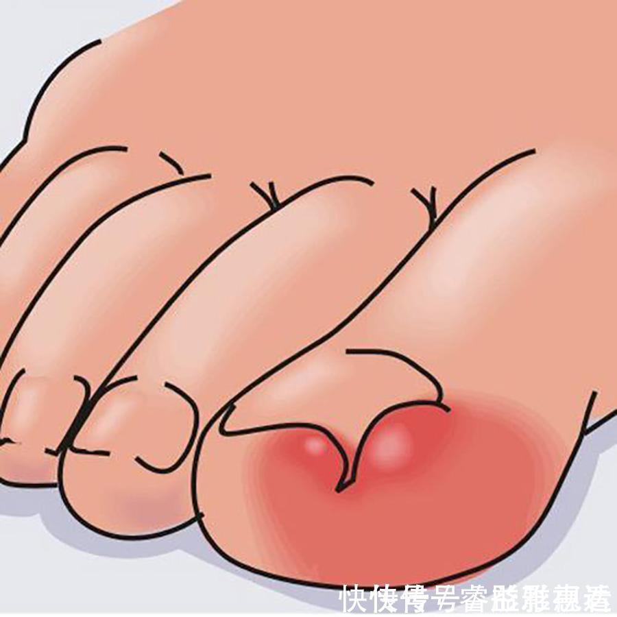 扭伤|左病右治,上病下治—尤其适合四肢部位疾病,可能用到,建议收藏