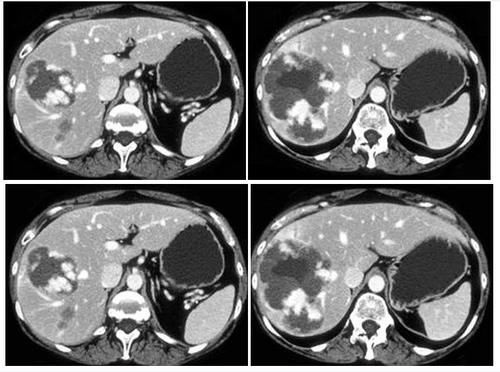 临床|癌症治疗3阶段,1年,3年,5年都是坎!度过才算“临床治愈”!