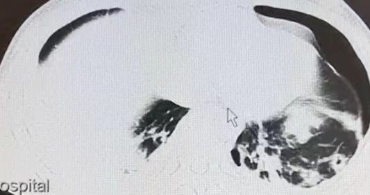 药引|头皮发麻！男子吃这个东西当药引，结果身体里长满寄生虫！