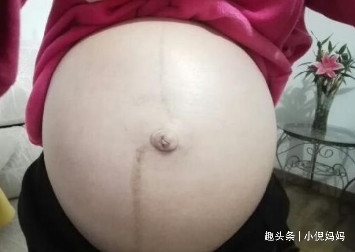 肚子|孕妇肚子上有“黑线”生男孩别再听信谣言，正确的说法是这样