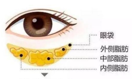 杨主任 杨甄宇眼部整形之祛眼袋手术!