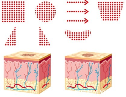 欧洲 co2点阵激光和欧洲之星哪个好?区别科普+优势解析,医美不盲目!