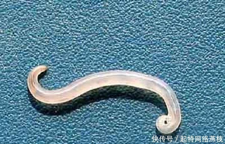 食物|8岁男孩肝脏长满虫子!医生:不要给孩子买这些食物,寄生虫太多