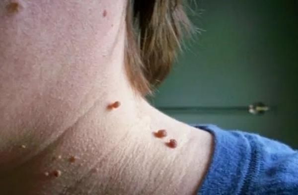 hpv感染|脖子、腋下莫名长出的＂小肉粒＂，是HPV感染？千万别抠！